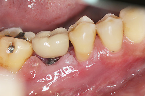 Реальный случай отторжения зубного импланта