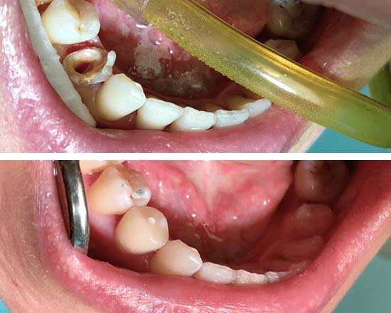 Что делать, когда болит зуб под коронкой – стоматологическая клиника «Имплант Лаб»